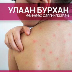 Улаан бурхан өвчин